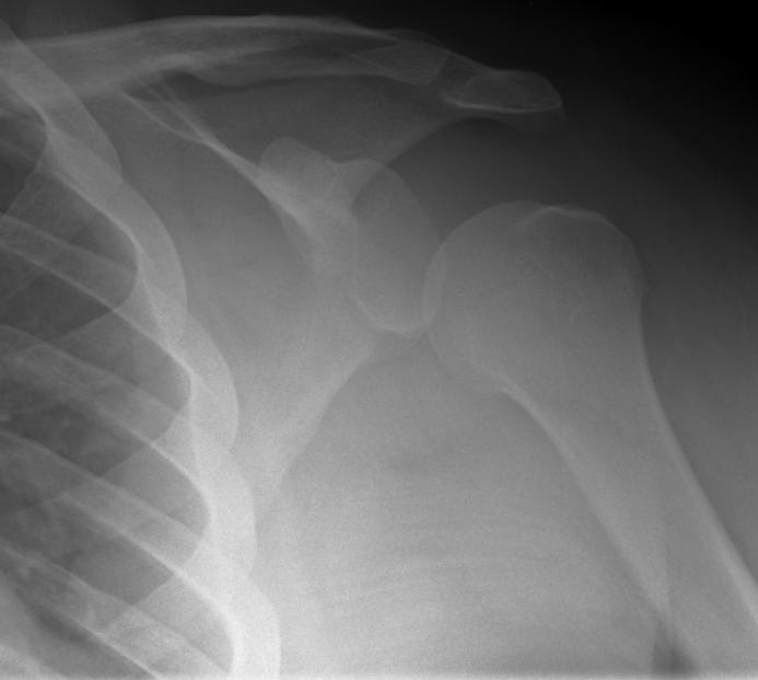 AP view of the left shoulder