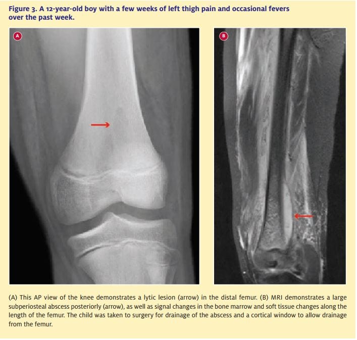  A 12-year-old boy with a few weeks of left thigh pain and occasional fevers over the past week.