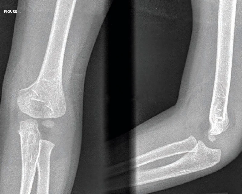 3 year boy elbow pain after a fall x-ray 1