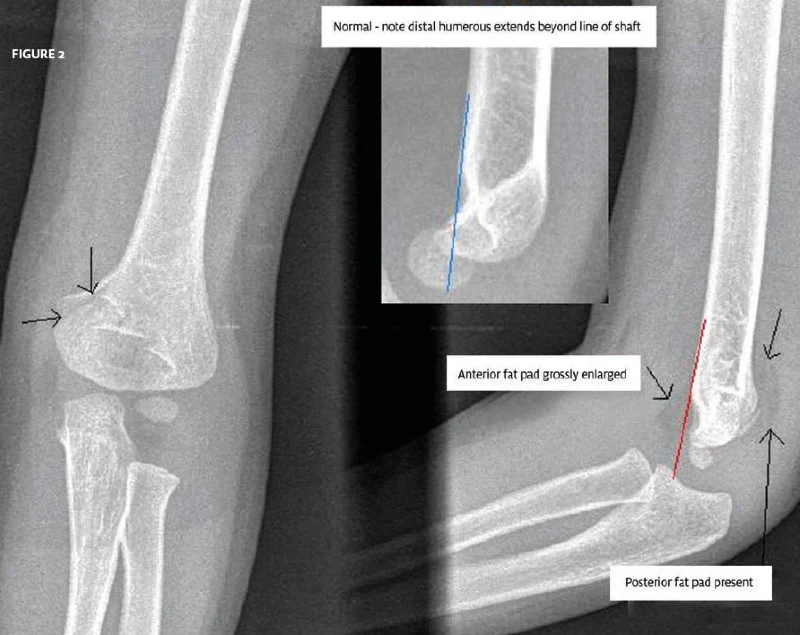 3 year boy elbow pain after a fall x-ray 2