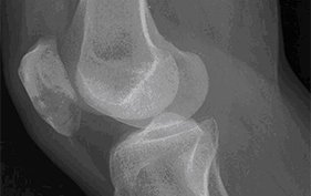 55-year-old man with knee pain after fall