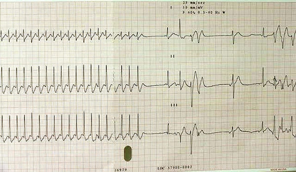 2-year-old boy with Williams syndrome suffers fever and cough