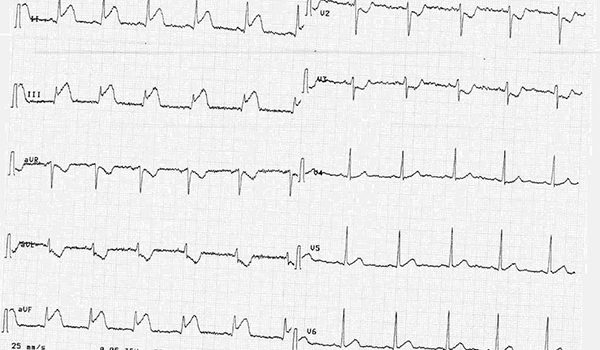 32-year-old male with burning sensation in chest