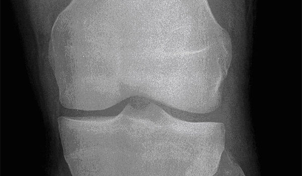 17-year-old boy experiencing pain from injured knee