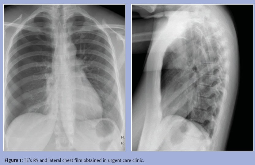 Spontaneous Pneumothorax x-ray views