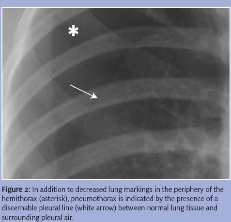 Spontaneous Pneumothorax Figure 2, Decreased Lung Markings and Discernable Pleural Line