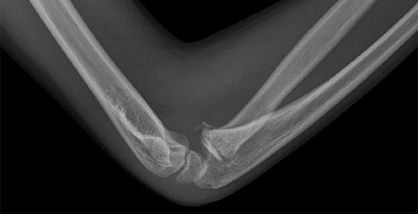 Clinical Challenges: X-Ray Image of girl's elbow