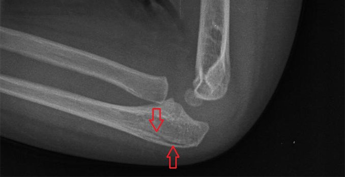 3-year-old boy with a blow to his right elbow