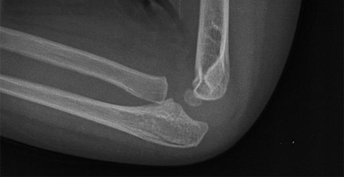 3-year-old boy with a blow to his right elbow