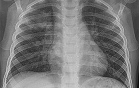 3-year-old boy with a cough and fever