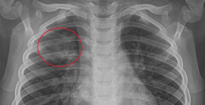 3-year-old boy with a cough and fever