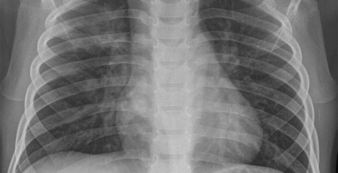 3-year-old boy with a cough and fever