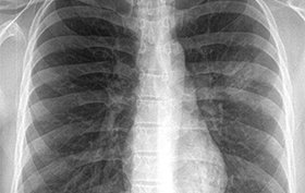 27-year-old man with a cough and fever