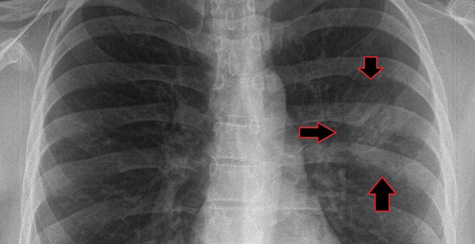 27-year-old man with a cough and fever