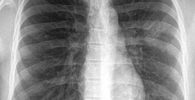 27-year-old man with a cough and fever