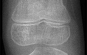 7-year-old girl with twisted knee after fall