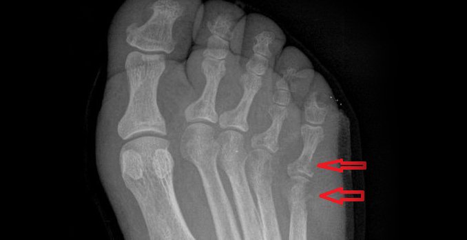 x-ray reveals evidence of bone destruction in the proximal fifth toe and of the distal metatarsal (arrows).