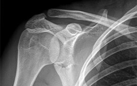 21-year-old man with a blow to his right shoulder