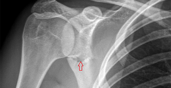 21-year-old man with a blow to his right shoulder