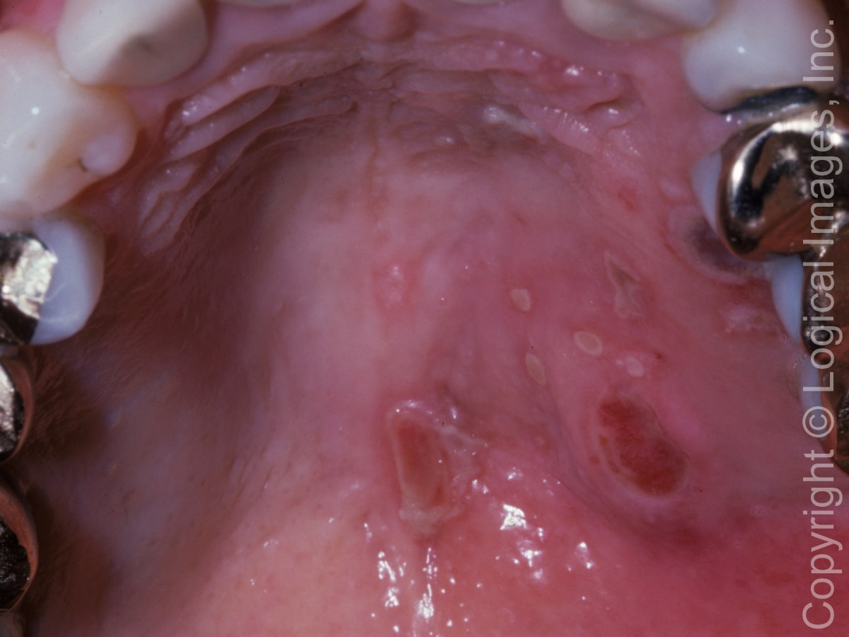 76 Year Old Woman With Sudden Ulcers On Roof Of Mouth Page 2 Of 2 Journal Of Urgent Care
