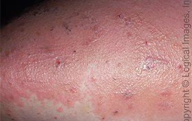 17-year-old male with quickly spreading rash