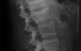 25-year-old man with back pain after falling 2 stories