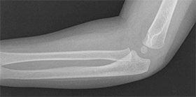 2 1/2-year old has swollen elbow after falling