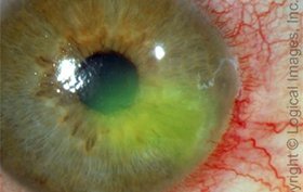 Patient with recurring sharp pain in left eye