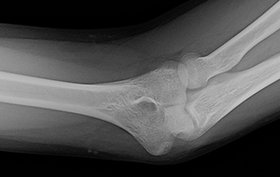 20-year-old man with left elbow pain and swelling