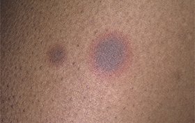 67-year-old African American male who developed two asymptomatic lesions on thigh