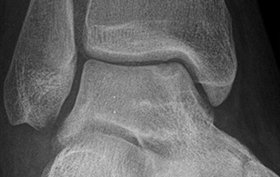 17-year-old female with an incidental finding in her right ankle