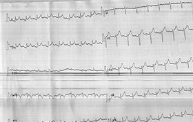 EKG taken of 57-year-old woman with chest pain