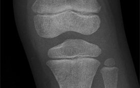 4-year-old boy with a blow to his left leg