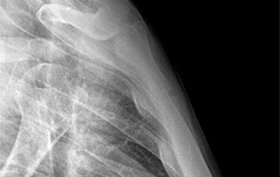 18-year-old man with a mild blow to his chest