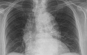90-year-old woman with a cough but no chest pain