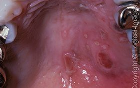 76-year-old woman with sudden ulcers on roof of mouth