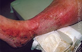 56-year-old woman with swollen, plaque covered leg