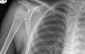 9-year-old boy injures shoulder in fall