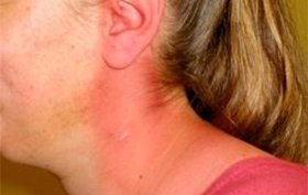 Patient experiencing intense pain and redness of skin