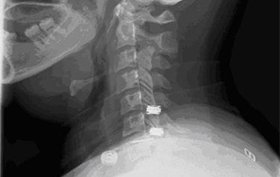 35-year-old female with worsening neck pain