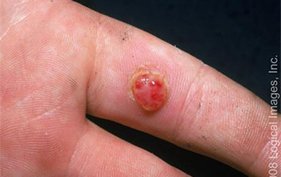 26-year-old woman with bleeding lesion