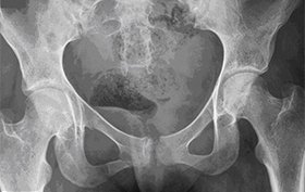 16-year-old girl receives blow to her hip