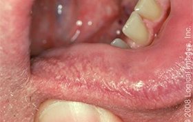 33-year-old male with new lesions on lips
