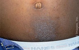 8-year-old boy experiencing rash on abdomen