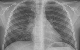 9-year-old girl has painful breathing after falling on chest