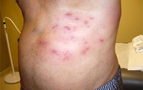 Type 2 diabetic male experiencing painful rash