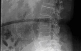 80-year-old man suffering lower back pain