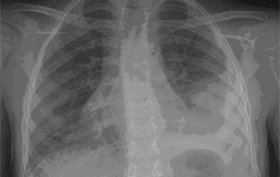 7-year-old boy with persistent fever and cough