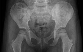 3-year-old girl with sudden pain in right hip