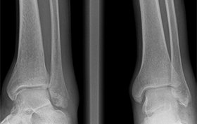 30-year-old male in severe discomfort after "twisting" ankle